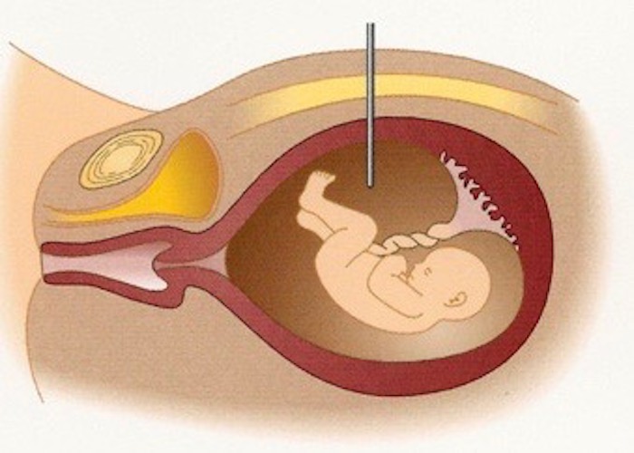 Amniocentesi